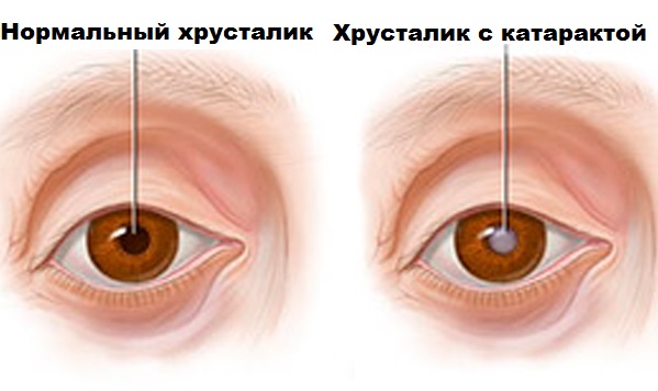 Операция на единственном глазу катаракта